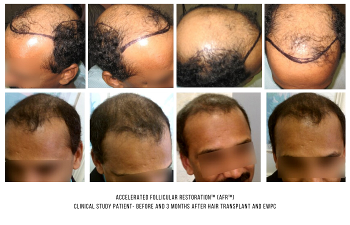 Washing Hair After Hair Transplant - Chicago, IL Shampoo Post-Surgery